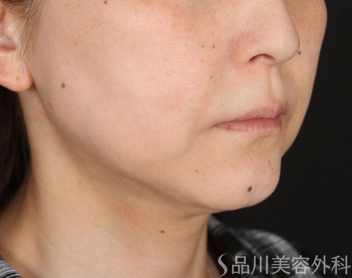 症例NO.74251のBEFORE写真