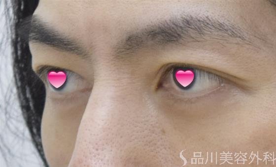 症例NO.51670のAFTER写真
