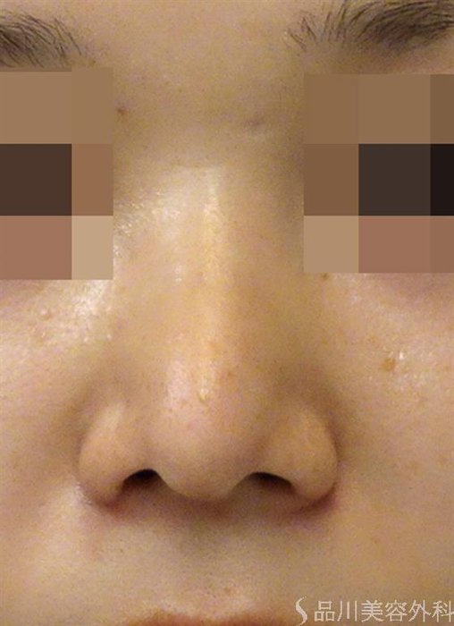 症例NO.40180のAFTER写真