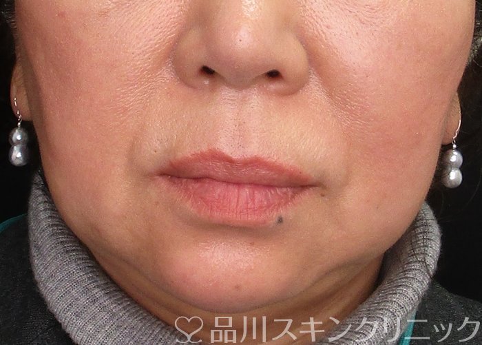 症例NO.70290のAFTER写真