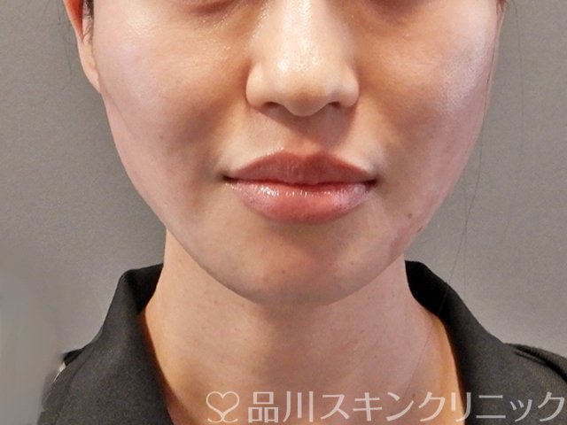 症例NO.64384のAFTER写真