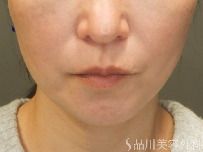 症例NO.70357のAFTER写真
