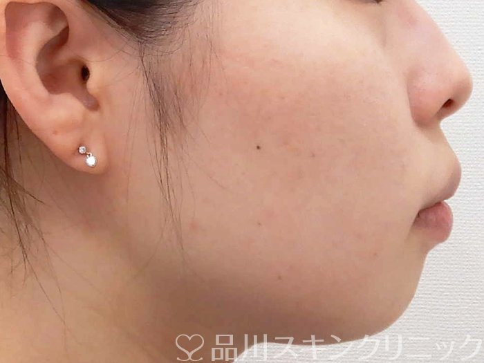 症例NO.63697のBEFORE写真