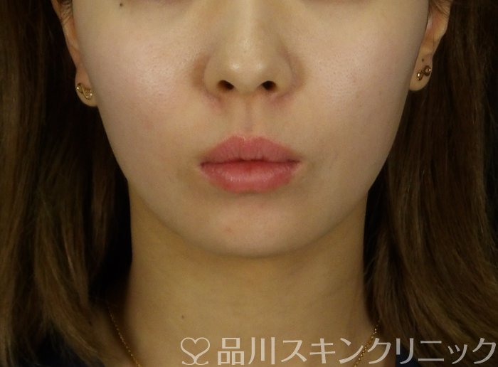 症例NO.72637のBEFORE写真