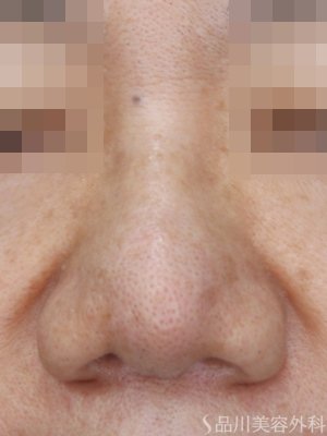 症例NO.73556のBEFORE写真