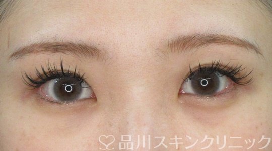 症例NO.72028のAFTER写真