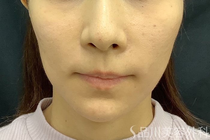 症例NO.69842のAFTER写真