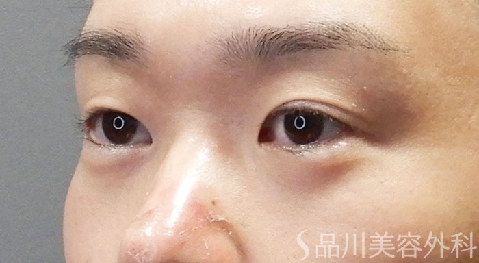 症例NO.71526のBEFORE写真