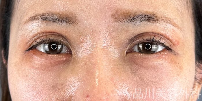症例NO.69604のAFTER写真