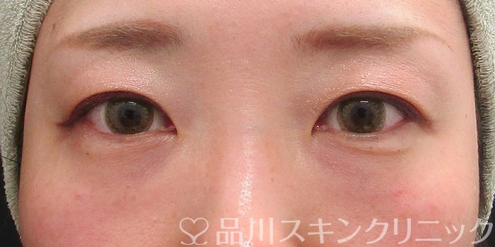 症例NO.70406のAFTER写真