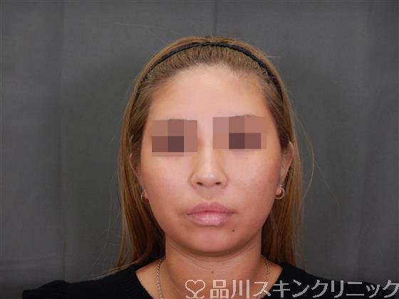 症例NO.56480のBEFORE写真