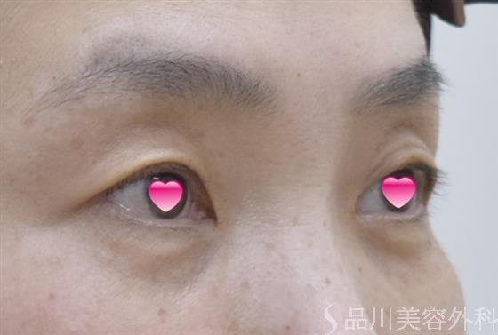 症例NO.54461のAFTER写真