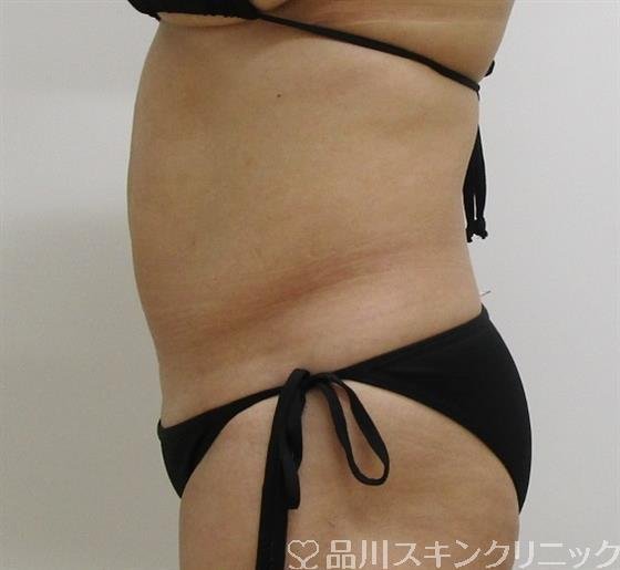 症例NO.35946のAFTER写真