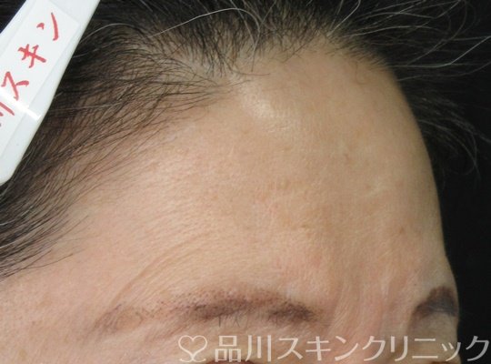 症例NO.70484のBEFORE写真