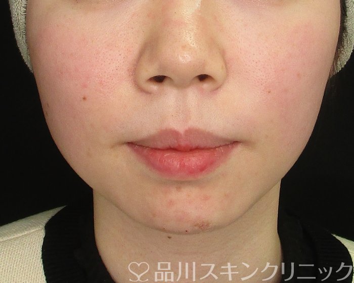 症例NO.69740のAFTER写真