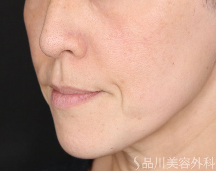 症例NO.71304のBEFORE写真