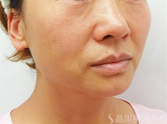 症例NO.44613のBEFORE写真
