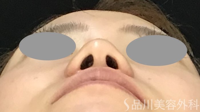 症例NO.70875のAFTER写真