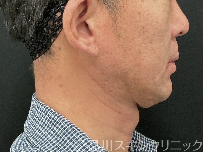 症例NO.73926のBEFORE写真