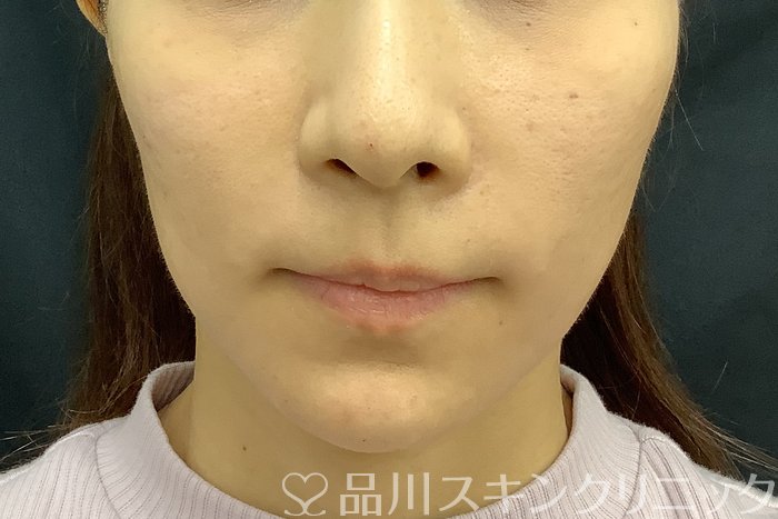 症例NO.69842のAFTER写真
