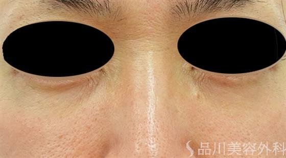 症例NO.46383のAFTER写真