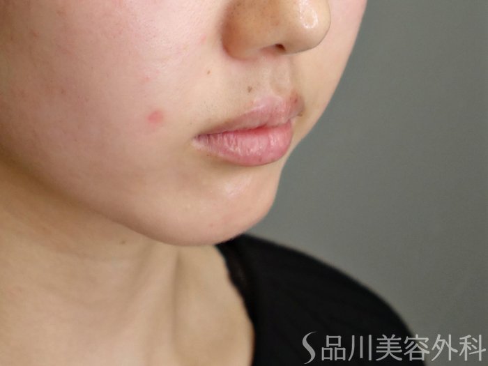 症例NO.69540のBEFORE写真