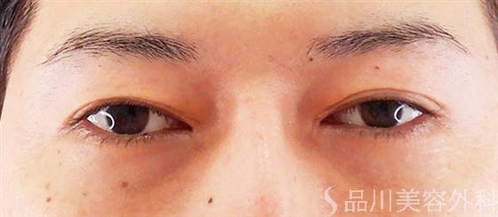 症例NO.61370のBEFORE写真