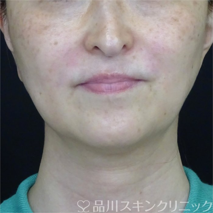 症例NO.70167のAFTER写真