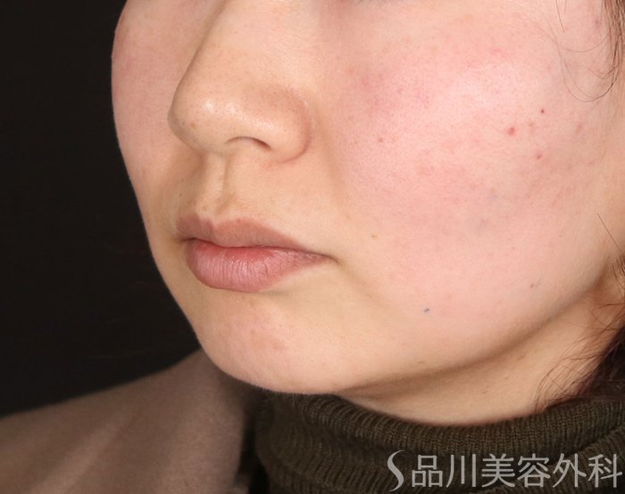 症例NO.73272のAFTER写真