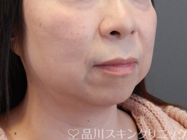 症例NO.69230のBEFORE写真