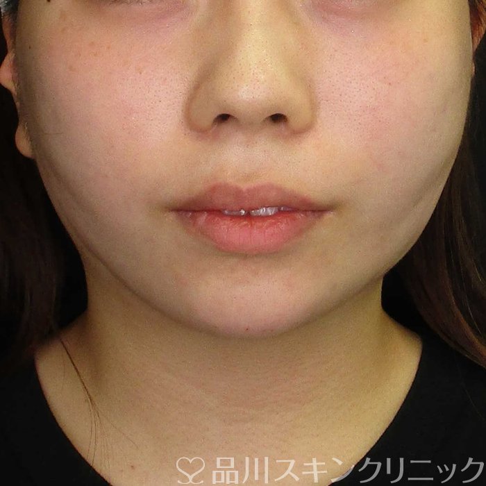 症例NO.67771のAFTER写真