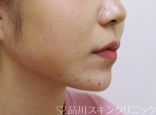 症例NO.65267のAFTER写真