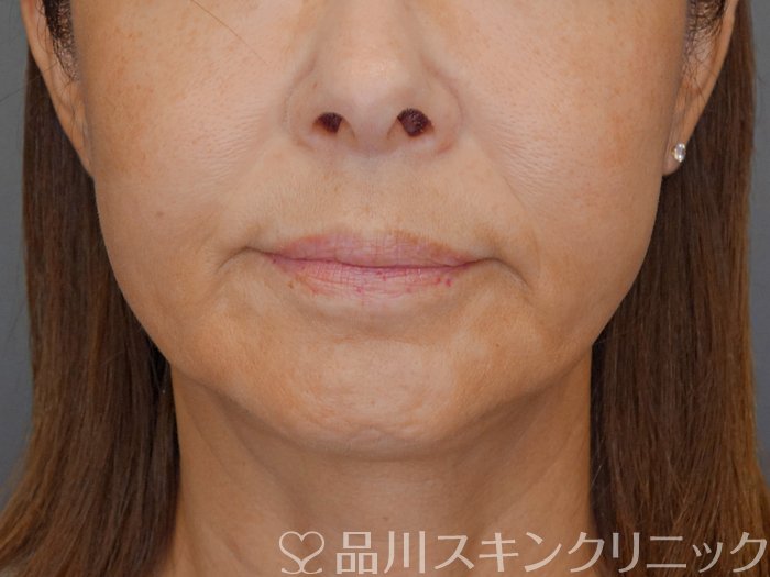 症例NO.71787のBEFORE写真