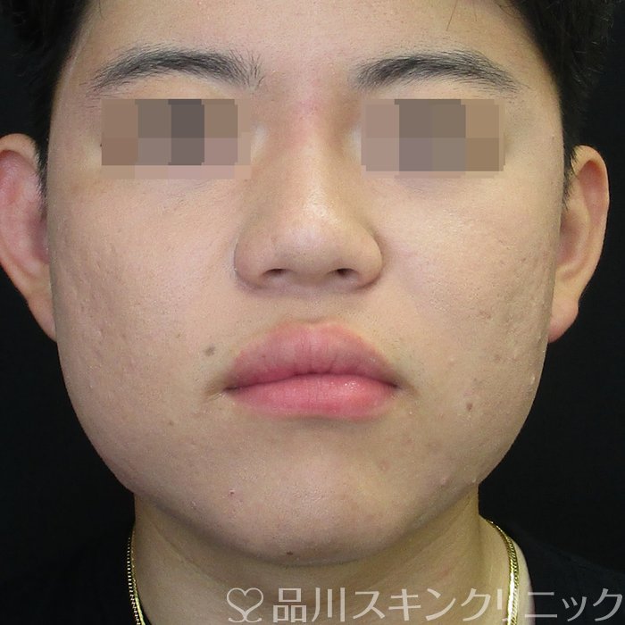 症例NO.73149のAFTER写真