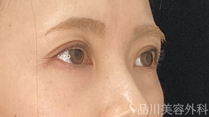 症例NO.71146のAFTER写真