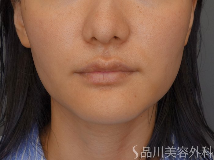 症例NO.71849のBEFORE写真