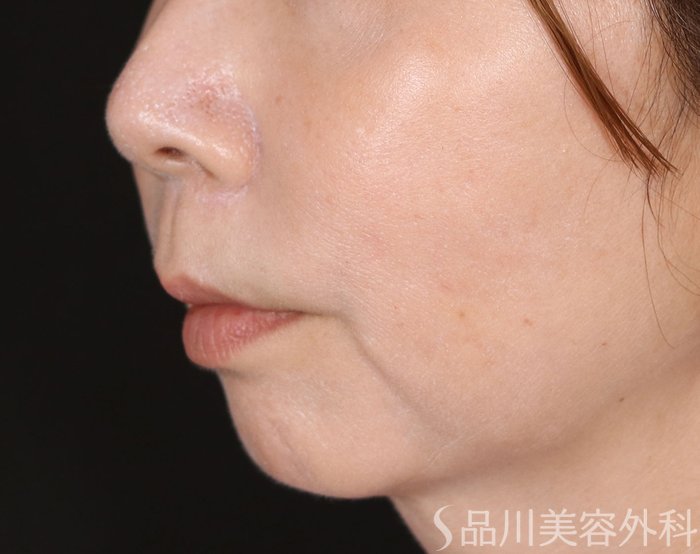 症例NO.71863のBEFORE写真