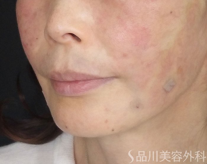 症例NO.65307のAFTER写真