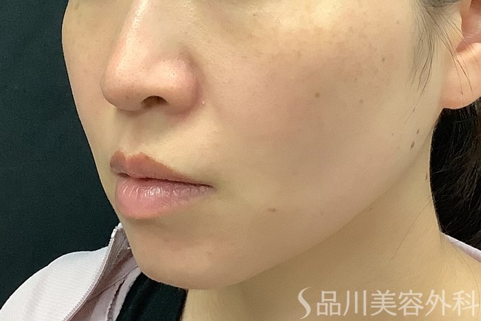 症例NO.71250のBEFORE写真