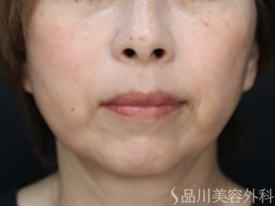 症例NO.74865のAFTER写真