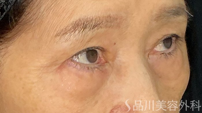 症例NO.71889のBEFORE写真