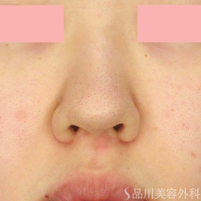 症例NO.71663のBEFORE写真