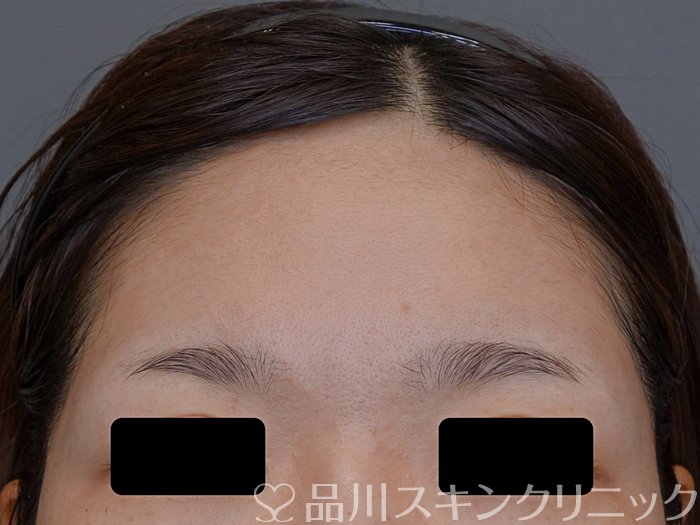 症例NO.74711のBEFORE写真