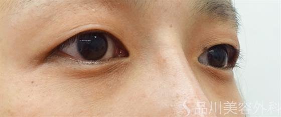 症例NO.45339のBEFORE写真