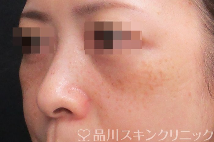 症例NO.75097のBEFORE写真