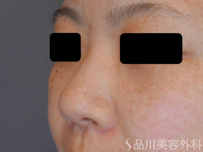 症例NO.71679のBEFORE写真