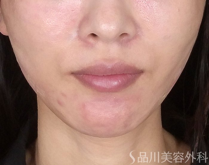 症例NO.65137のAFTER写真