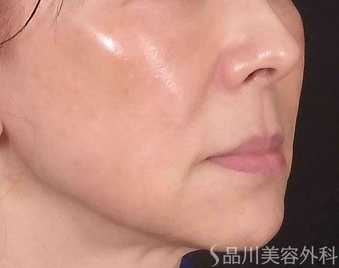 症例NO.69735のBEFORE写真