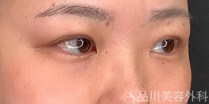 症例NO.71234のAFTER写真