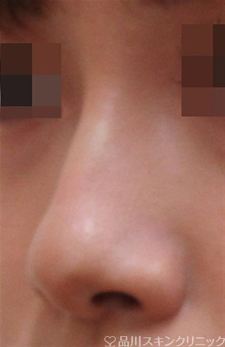 症例NO.32232のAFTER写真